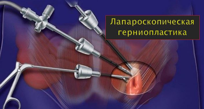 Лапароскопическая холецистэктомия. Удаление желчного пузыря при помощи проколов
