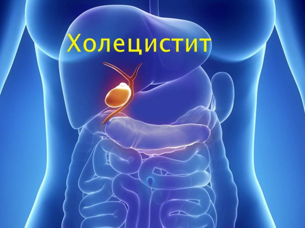 Холецистит