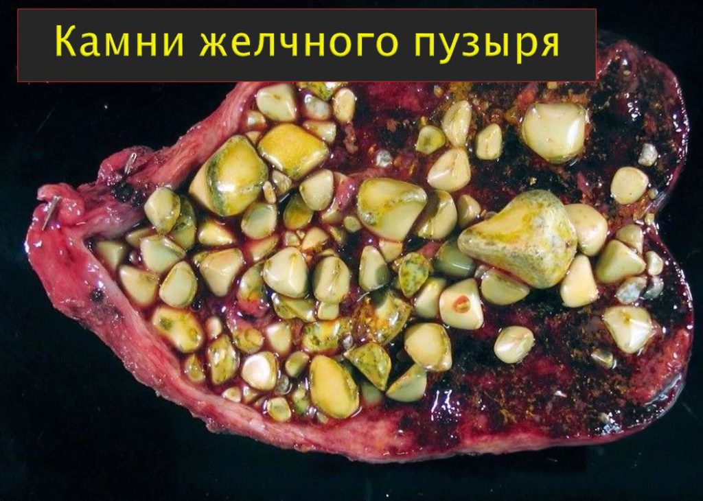 Камни в желчном пузыре