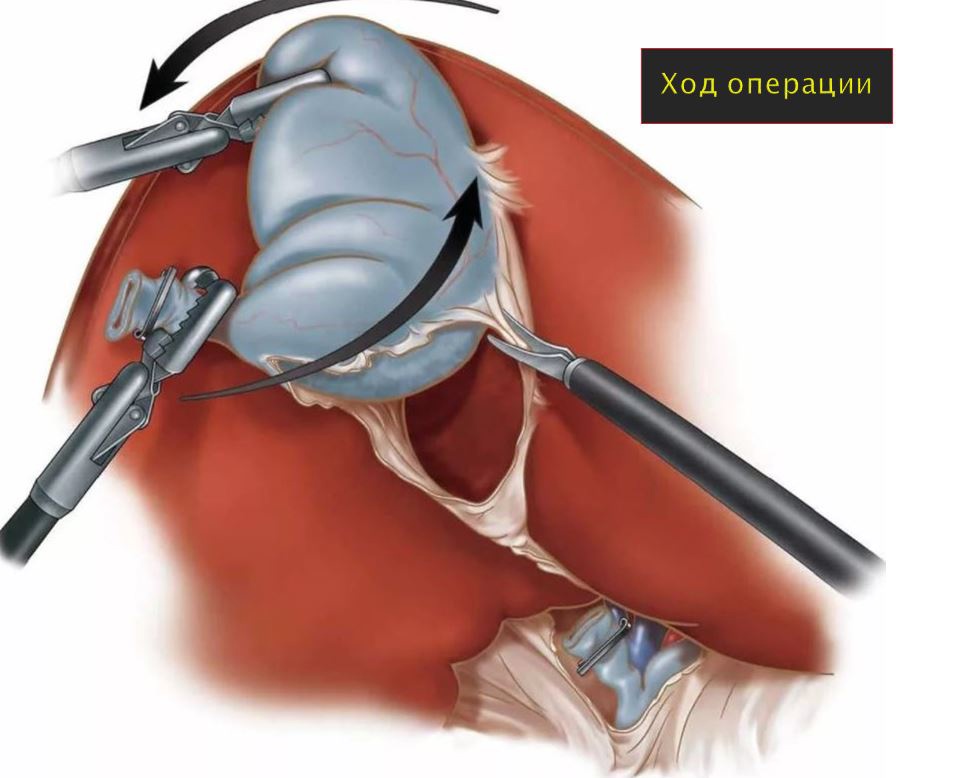 холецистэктомия
