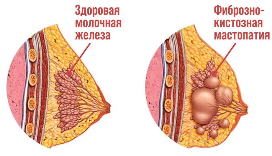 Фиброзно-кистозная мастопатия молочных желез