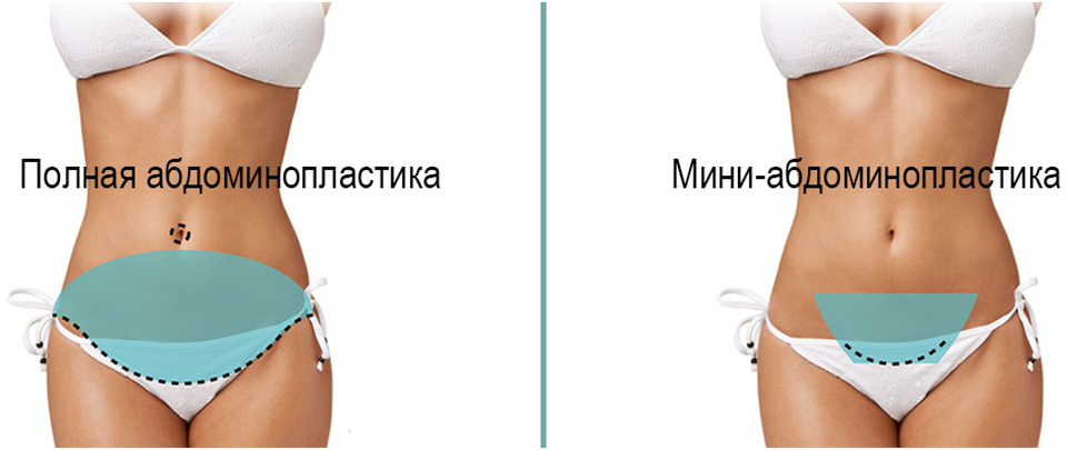 полная абдоминопластика и мини абдоминопластика